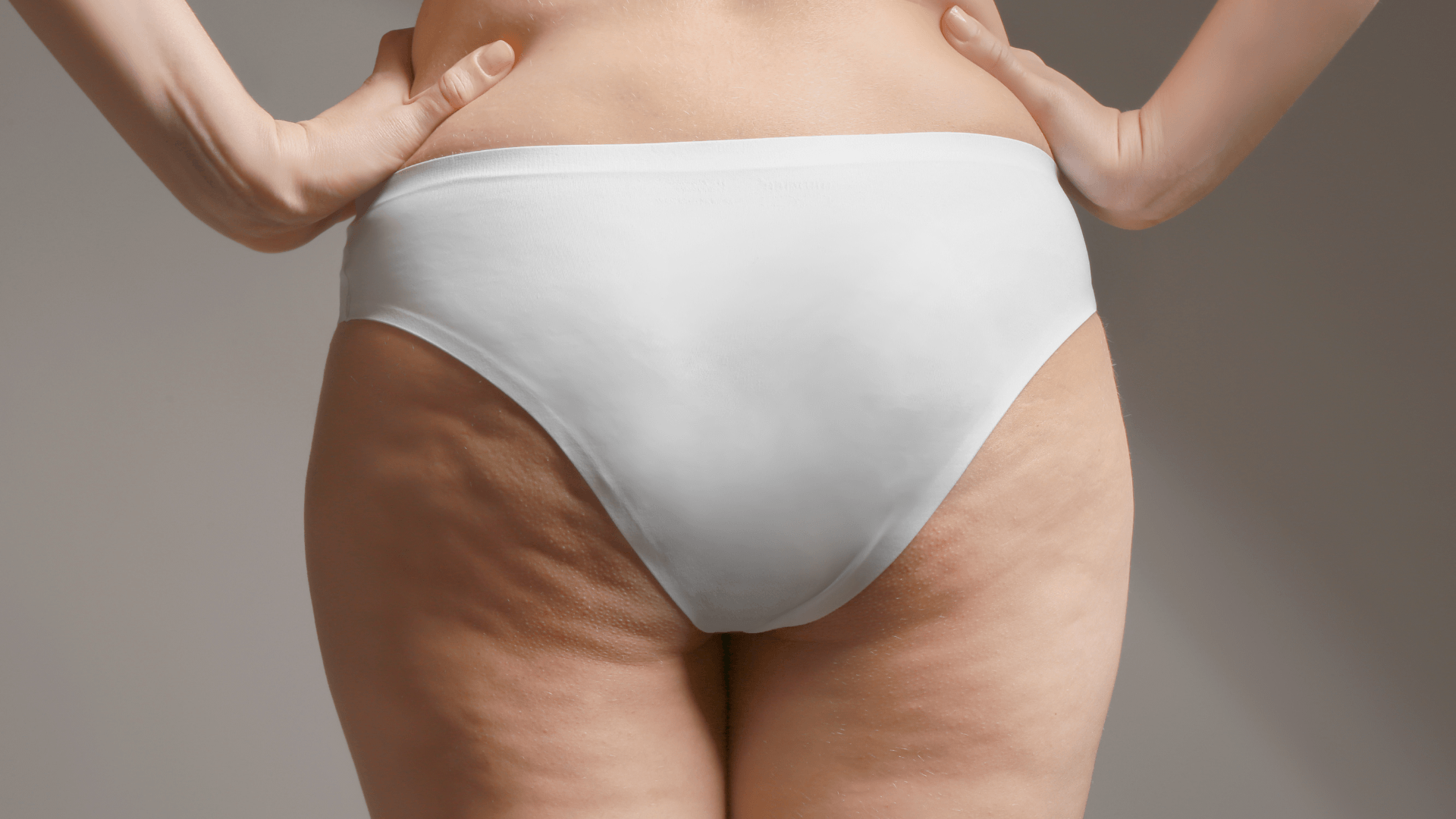 Close-up of a woman’s lower body showing visible cellulite on the thighs and buttocks, commonly treated with non-invasive cellulite reduction treatments like BTL Emtone or X-Wave.